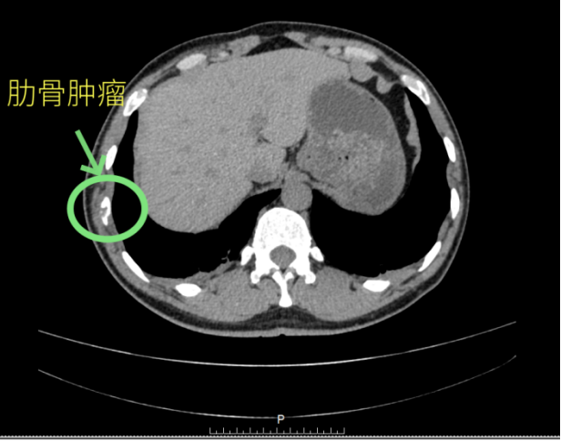肋骨罕見病例368