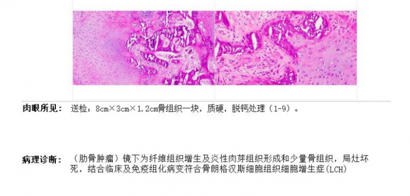 肋骨罕見病例622